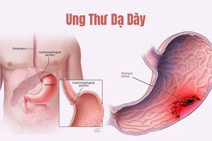 Nhận Biết Sớm Biểu Hiện Ung Thư Dạ Dày: 10 Dấu Hiệu Cần Lưu Tâm Khám Nhận Biết Sớm Biểu Hiện Ung Thư Dạ Dày: 10 Dấu Hiệu Cần Lưu Tâm Khám