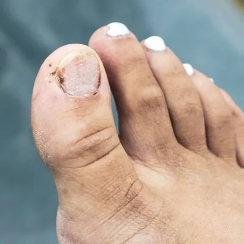 Cách Trị Bầm Và Thối Móng Chân Do Mang Giày: Hướng Dẫn Chi Tiết, Hiệu Quả Cách Trị Bầm Và Thối Móng Chân Do Mang Giày: Hướng Dẫn Chi Tiết, Hiệu Quả