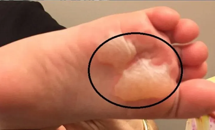 Cách Xử Lý Bỏng Rát Chân Do Ma Sát Giày Đúng Cách & Nhanh Lành Cách Xử Lý Bỏng Rát Chân Do Ma Sát Giày Đúng Cách & Nhanh Lành
