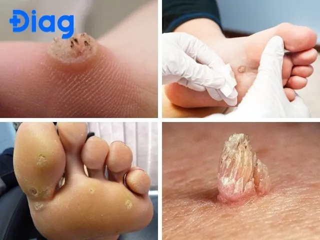 Cách Xử Lý Bỏng Rát Chân Do Ma Sát Giày Đúng Cách & Nhanh Lành Cách Xử Lý Bỏng Rát Chân Do Ma Sát Giày Đúng Cách & Nhanh Lành