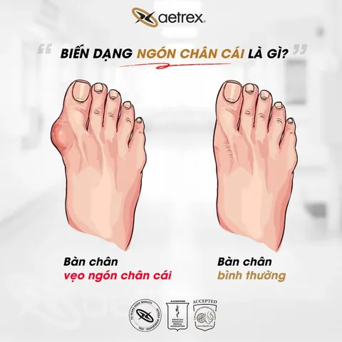 Chọn Giày Phù Hợp Cho Nam Chân To Đi Giày Nhỏ, Lòi Ngón Chân: Hướng Dẫn Chi Tiết