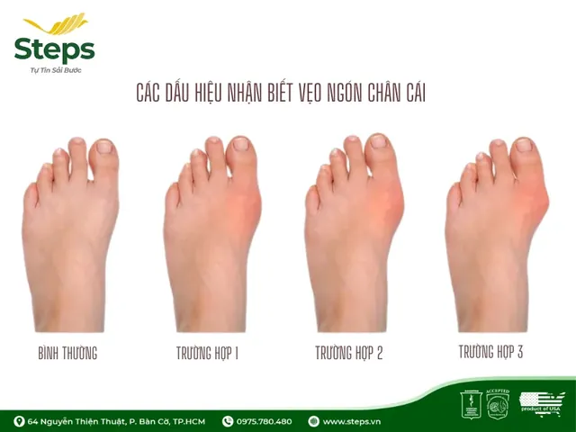 Bí Quyết Chọn Giày Vừa Vặn Giúp Chân Không Đau: Hướng Dẫn Chi Tiết Cho Mọi Đối Tượng Bí Quyết Chọn Giày Vừa Vặn Giúp Chân Không Đau: Hướng Dẫn Chi Tiết Cho Mọi Đối Tượng