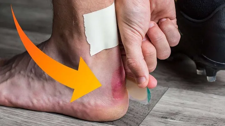 Bị Trầy Gót Chân Khi Mang Giày Đá Bóng: Nguyên Nhân, Cách Khắc Phục Và Phòng Tránh Hiệu Quả
