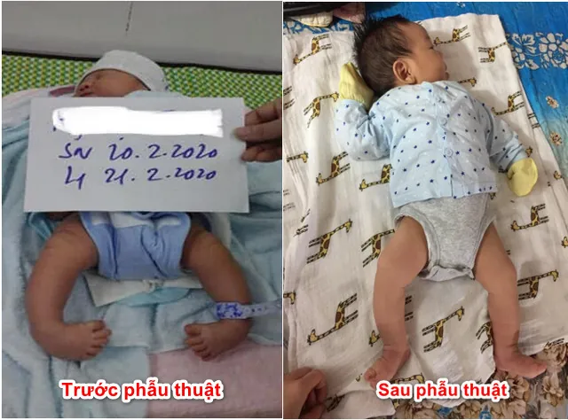 Hướng Dẫn Chi Tiết Cách Mang Giày Nẹp Cho Bé Chân Khoèo Đúng Cách Và Hiệu Quả Hướng Dẫn Chi Tiết Cách Mang Giày Nẹp Cho Bé Chân Khoèo Đúng Cách Và Hiệu Quả